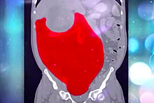 Для удаления огромной опухоли из пациента выкачали кровь