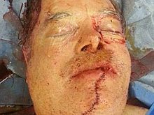 Мужчина распилил себе лицо бензопилой и сам добрался до врачей