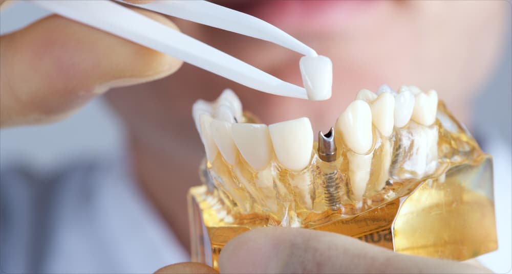 Специалисты УГАТУ разработали импортозамещающие зубные имплантаты