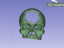 В РКБ Татарстана с помощью 3D-принтера раненому бойцу восстановили кости черепа