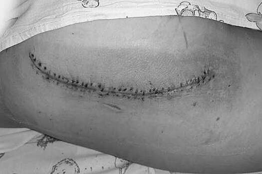 В Подмосковье спасли ребенка, врезавшегося в стеклянную дверь