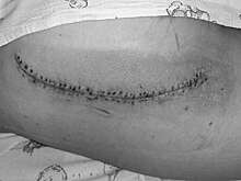 В Подмосковье спасли ребенка, врезавшегося в стеклянную дверь