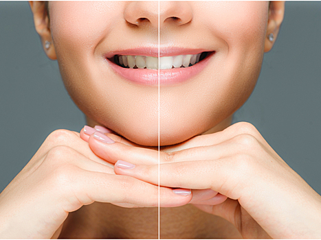 8 фактов об отбеливании зубов, которые лучше узнать до процедуры
