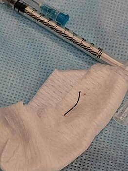 Кировчанину из под колес автомобиля в глаз прилетела проволока