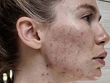 «Невыносимо». Телезвезда показала лицо во время борьбы с акне