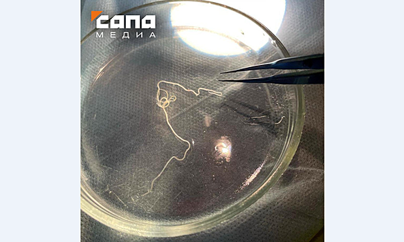 "Что-то шевелится": глист поселился в глазу жительницы Уфы