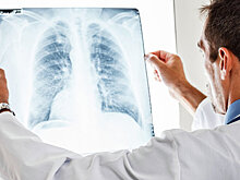 Найдена причина появления туберкулеза