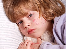 В течение января 46 не привитых жителей Челябинской области заболели корью