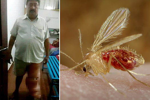 После укуса комара в ноге мужчины начали развиваться паразиты