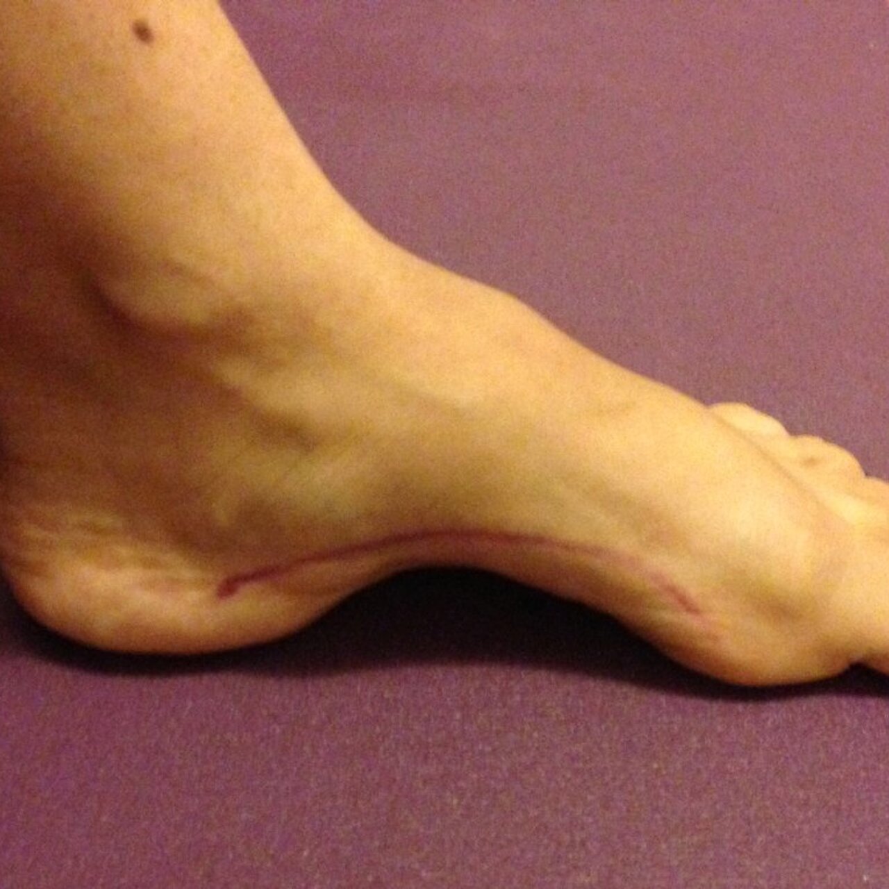 Нормальный свод стопы и плоскостопие. Нормальная стопа и плоскостопие. Большой изгиб стопы. Стопа человека. Плоскостопие 3 степени вальгус.