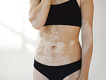 Врач Галлямова: с болезнью витилиго можно столкнуться в любом возрасте