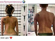 Регина Тодоренко показала результат борьбы со сколиозом: «Годы лечения и непринятия своего тела»