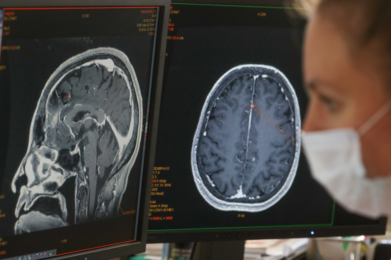 Neuralink Маска ищет нового участника эксперимента с мозговым чипом
