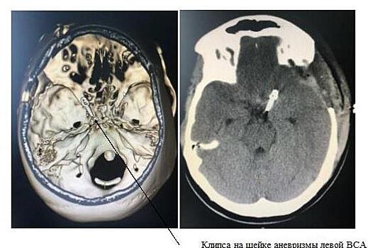 Нейрохирурги больницы Вересаева в САО спасли 21-летнюю пациентку