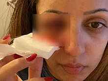 Daily Mail: в Великобритании женщина ослепла после посещения бассейна