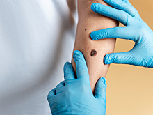 Исследователи определили опасный размер родинки