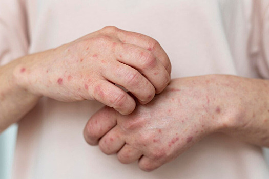 Врач рассказал, можно ли умереть от ветрянки