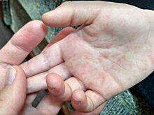 В Калужской области зарегистрирована вспышка кори