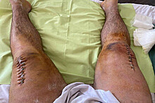 Сломавший ноги при приседании со штангой пауэрлифтер показал последствия страшной травмы