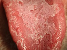 Врач назвала возможные причины «географического языка»