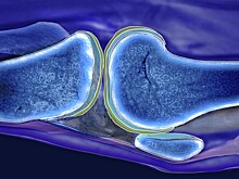 Ученые выяснили, что провоцирует развитие остеоартрита у женщин