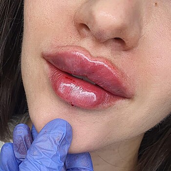 Из-за филлеров над верхней губой появились «усы»? Рассказываем, что делать