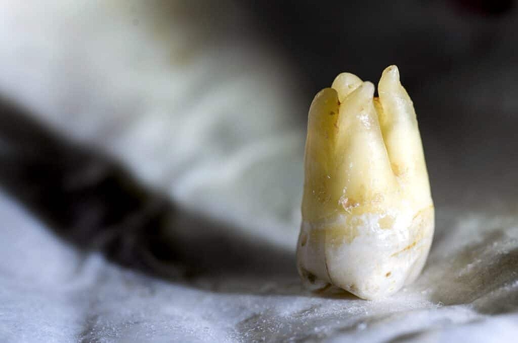 Ученые разработали наноботов для лечения зубных каналов