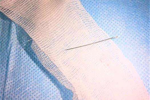 В Чувашии врачи удалили швейную иглу из печени пациентки