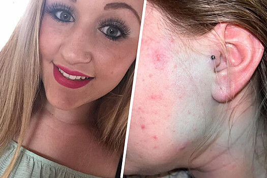 Британка попала в больницу с посиневшим лицом после прокола уха