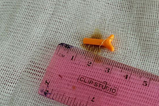 Девушка 20 лет проходила с деталью от конструктора в ухе