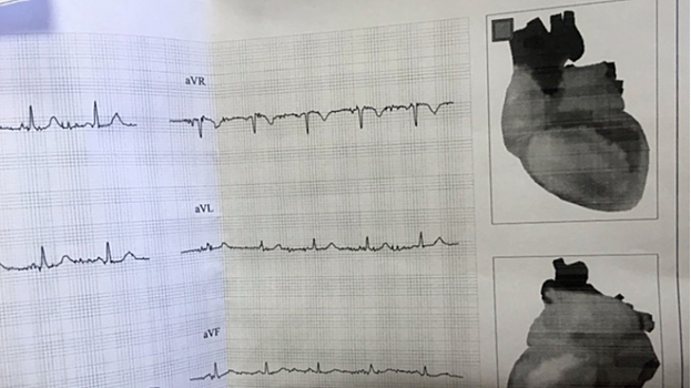 В Саратовской области резко выросла смертность от болезней сердца