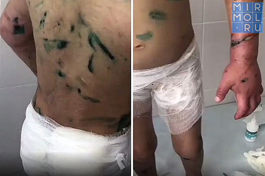 Аишу из Ингушетии ждет ампутация руки