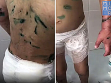 Аишу из Ингушетии ждет ампутация руки