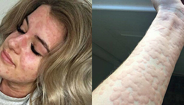 «У меня аллергия на холод»: 21-летняя канадка каждый день может умереть от анафилактического шока