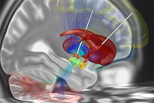 Названы опасные последствия глубокой стимуляции мозга