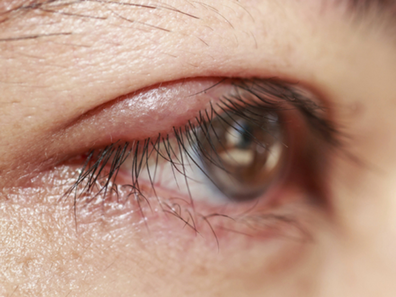 как лечить на глазу ячмень нижнем. заболевания век ячмень. пузырьки внутри нижнего века. этапы развития ячменя на глазу. как лечить на глазу ячмень нижнем.
