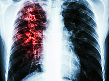 Как определить туберкулез на ранней стадии