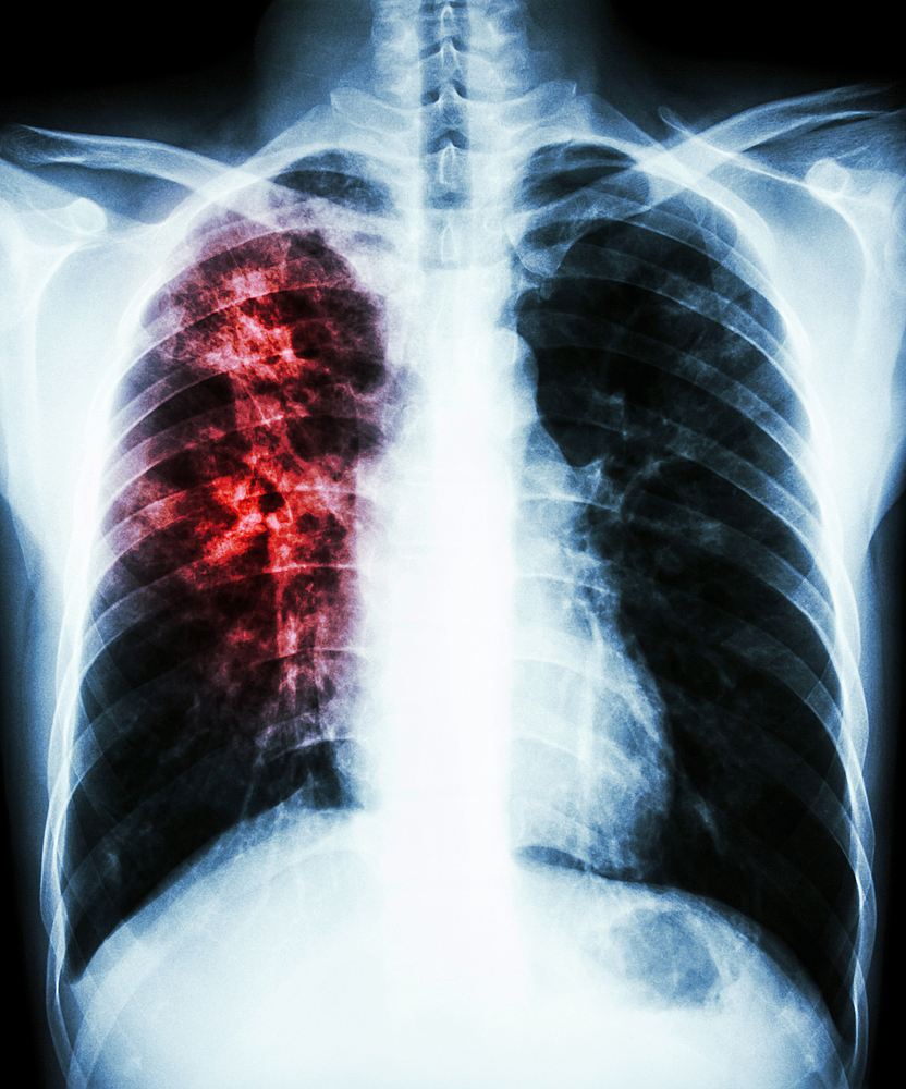 Легкие больного туберкулезом рентген