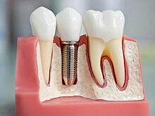 Врач-стоматолог Андрей Елизаров рассказал о плюсах и минусах зубной имплантологии