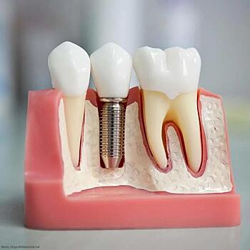 Врач-стоматолог Андрей Елизаров рассказал о плюсах и минусах зубной имплантологии
