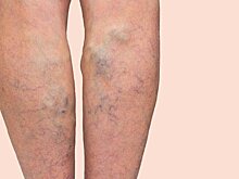 Варикозное расширение вен грозит смертельно опасными тромбами