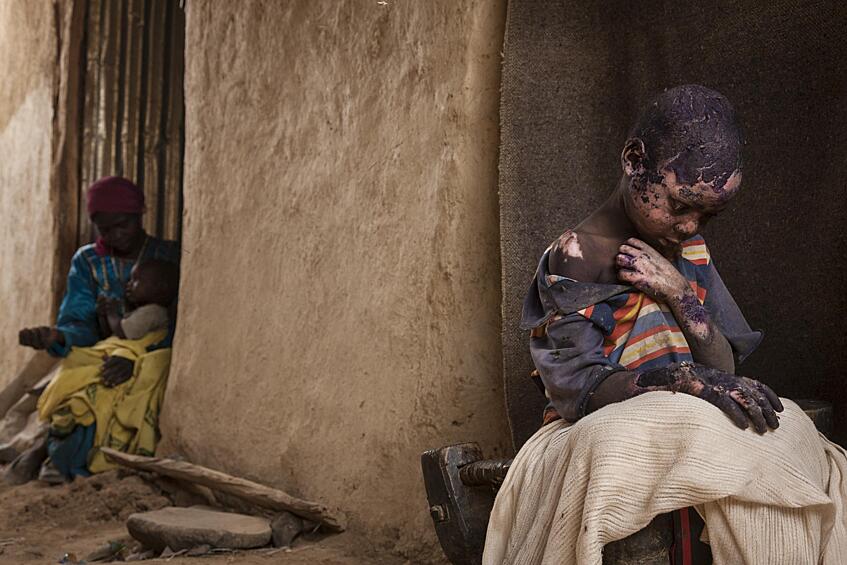 Второе место в категории «Проблемы современности. Одиночная фотография» занял снимок американского фотографа Adriane Ohanesian. На фото: 7-летний суданский мальчик, получивший сильный ожог от разорвавшейся около его дома бомбы