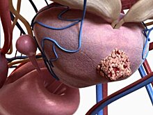 Лучевая терапия недооценивается в лечении рака простаты