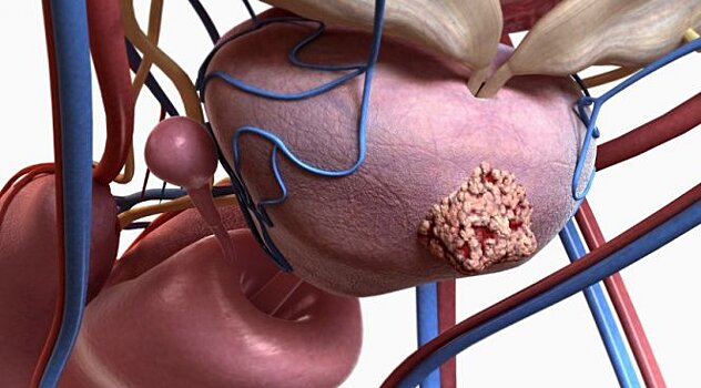 Предложен способ раннего выявления безнадежного рака простаты