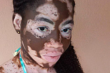 Африканская девушка с разноцветной кожей стала моделью