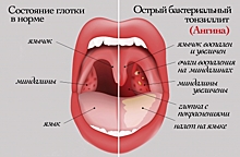 Как избавиться от ангины и боли в горле всего за несколько часов!