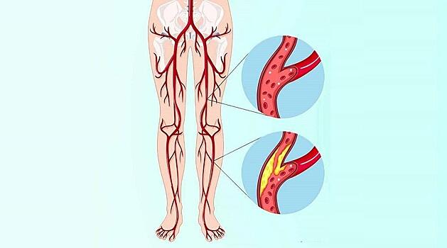Ученые выяснили, что хирургия уменьшает боль в ногах у 100% пациентов с ЗПА