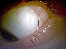 Хирурги спасли девочке глаз с вросшим в него волосом