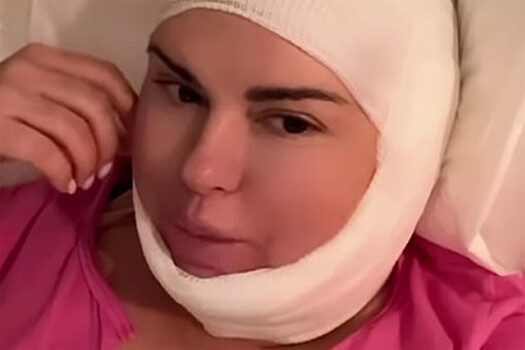 Певица Анна Семенович показала селфи после липосакции лица