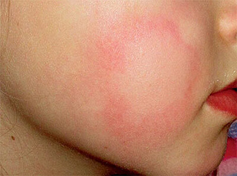 Чем отличается сезонная аллергия от ОРВИ